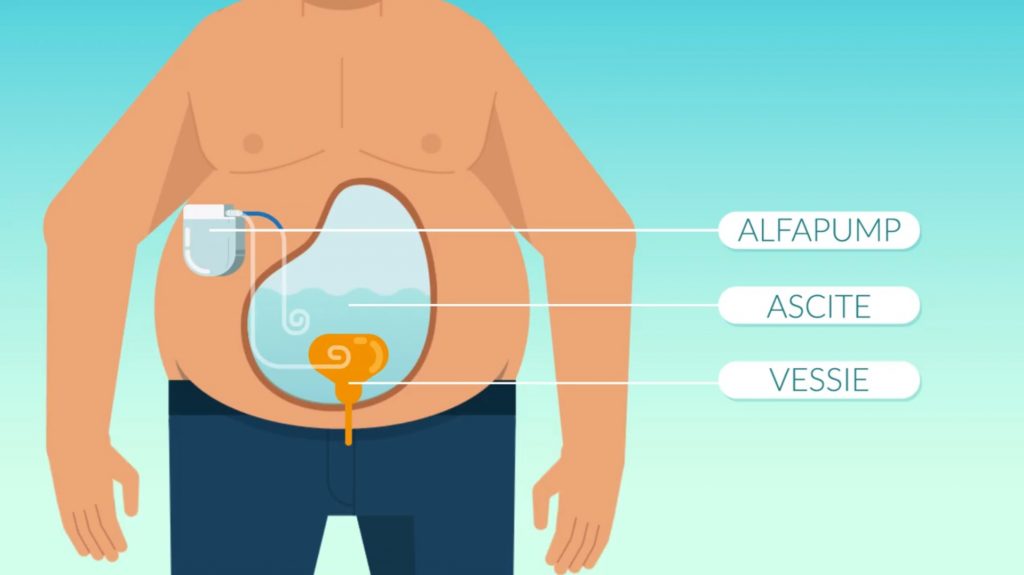 L’alfapump, un traitement prometteur pour améliorer le transit vers la vessie